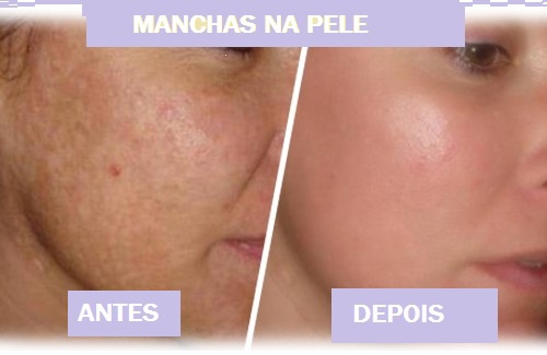 Que não houvesse lugares de pigmentary em uma cara
