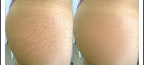 estrias-antes-e-depois