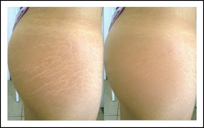 estrias-antes-e-depois