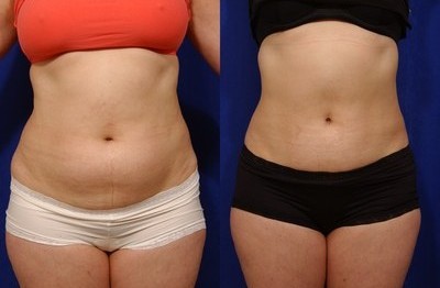 abdominoplastia-8-400×300