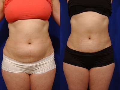 abdominoplastia-8-400×300