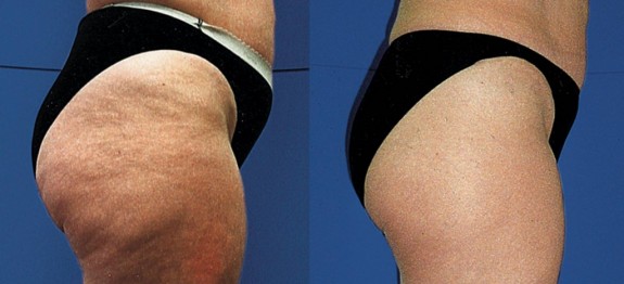 como-deve-ser-sua-dieta-para-eliminar-a-celulite-1024×723