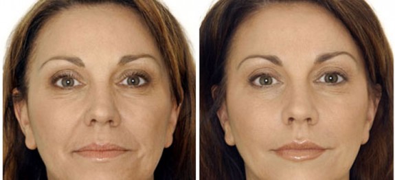 before-after-botox3-gala-b