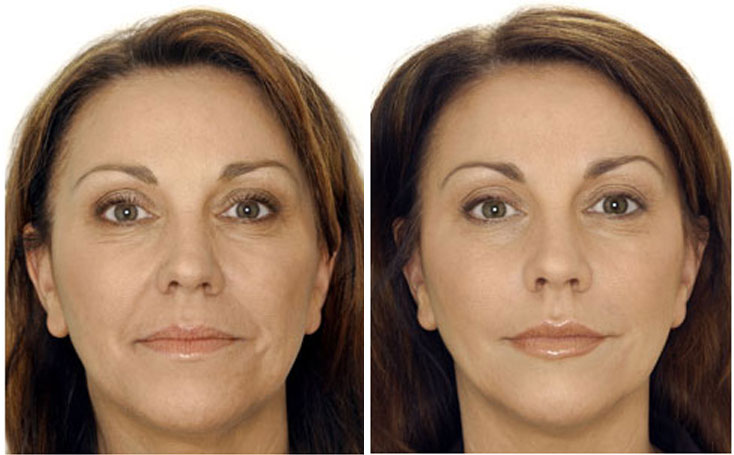 before-after-botox3-gala-b