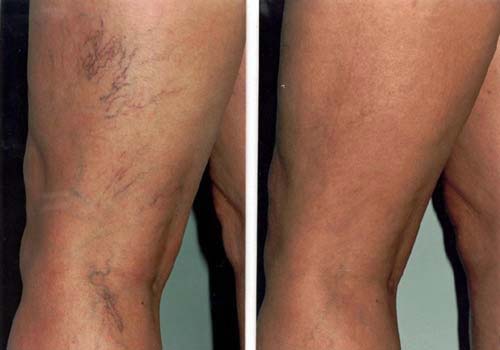 Como eliminar vasinhos e varizes