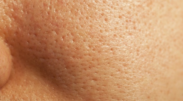 Tratamento caseiro para poros dilatados