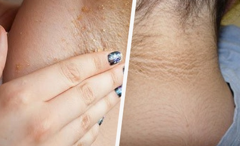 Como clarear as axilas e o pescoço naturalmente?