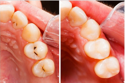 Remédios naturais para tratar a cárie