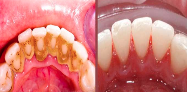 Truque para remover a placa bacteriana em 5 minutos, e sem sair de casa!