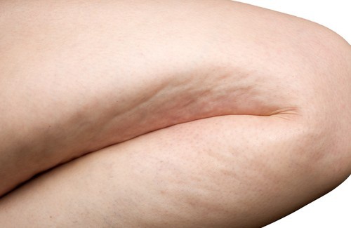 Celulite-500×325-500×325