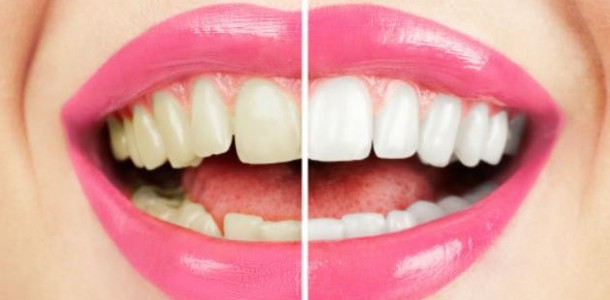 Clareamento-dos-dentes-610×300