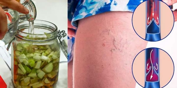 Elimine-varizes-microvarizes-e-aranhas-vasculares-com-este-poderoso-remédio-natural