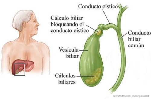 Calculos-na-vesicula-500×326-500×326