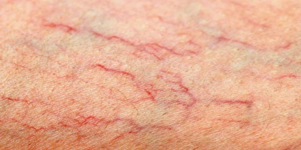 O-que-fazer-quando-começam-a-surgir-varizes