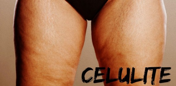 celulite-causas-610×300