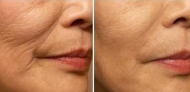 rugas-tratamento-610×296