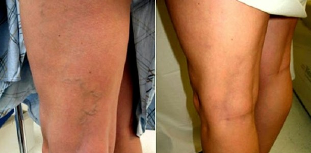 varizes-óleo-de-alho.jpg-edit-610×300