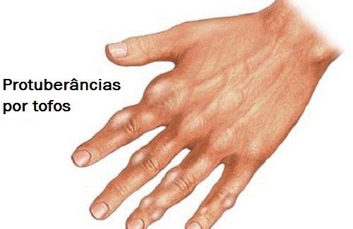 ácido-úrico-500×325