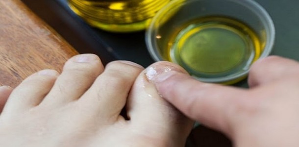 fungos-nas-unhas-610×300