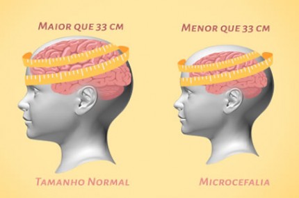 Afinal, o que acontece com um bebê que nasce com microcefalia? Entenda ...