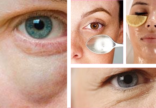 Retention Welcome Homeless Chega de bolsas embaixo dos olhos! Dicas simples para combatê-las - Veja a Receita: Retention Welcome Homeless Chega de bolsas embaixo dos olhos! Dicas simples para combatê-las - Veja a Receita: