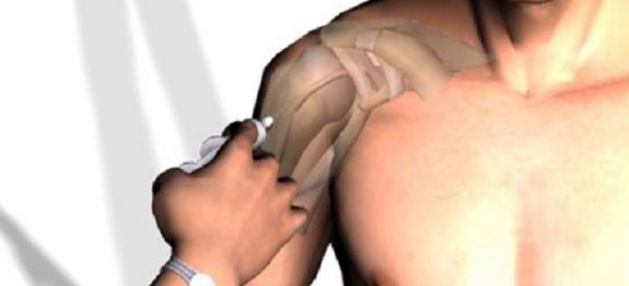 dor_no_ombro_-_edit_0