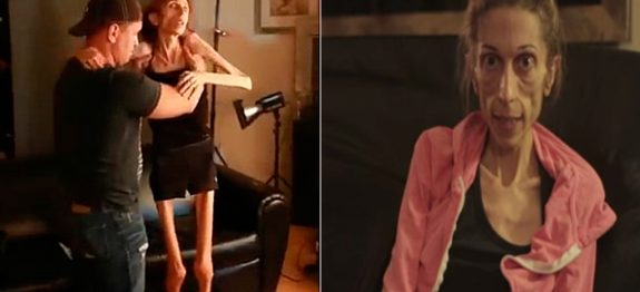 large_anorexia-capinha