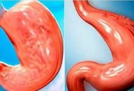 reduzir_estomago_-_edit