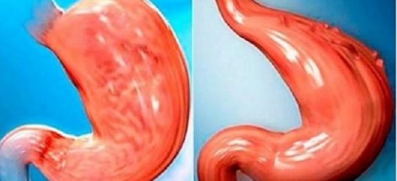 reduzir_estomago_-_edit