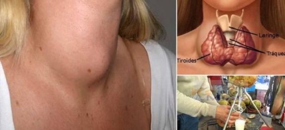 tireoide_-_toxinas