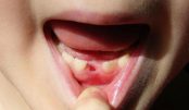 large_dentess