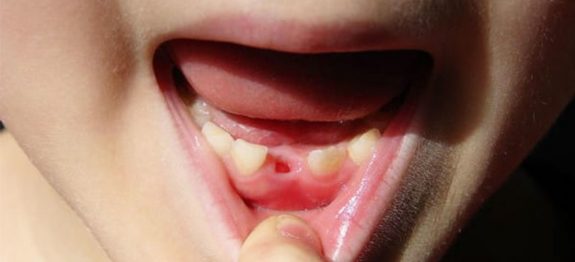large_dentess