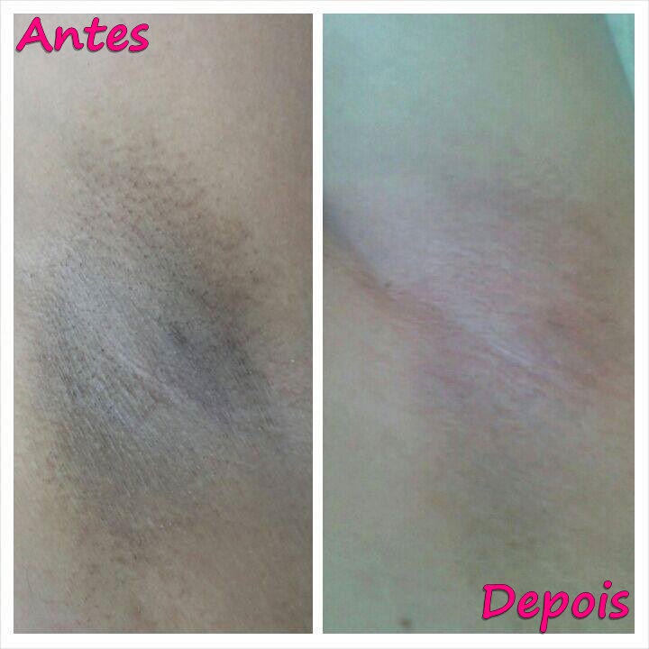 Diga adeus às manchas escuras e irritações na virilha, axilas e coxas ...