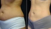 barriga_-_dieta_-_14_dias_ed