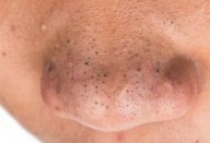 cravos-no-rosto-102016-1400×800