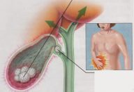 vesicula_sintomas_de_pedra