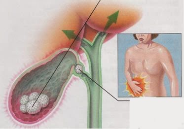 vesicula_sintomas_de_pedra