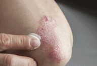 psoriase_-_novo-1-Copy-640×381