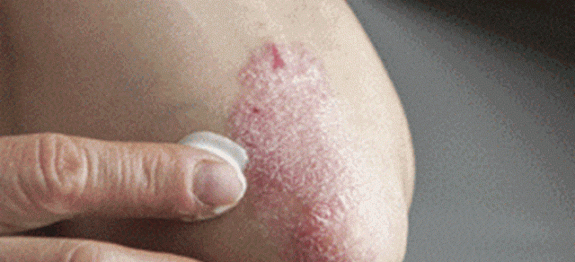 psoriase_-_novo-1-Copy-640×381