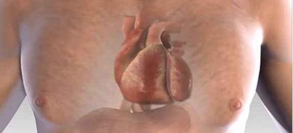 ataque_cardiaco_-_novo_ed