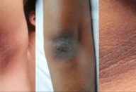 axilas_joelhos_e_cotovelos_escuros_-_novo