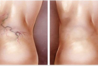 aranhas_-_pernas_-_novo (1)