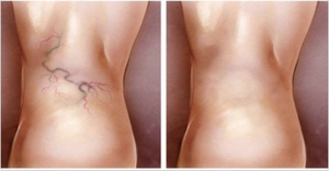 aranhas_-_pernas_-_novo (1)