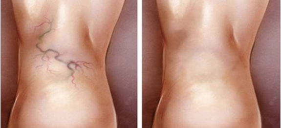 aranhas_-_pernas_-_novo (1)