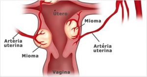 cistos_e_mioma