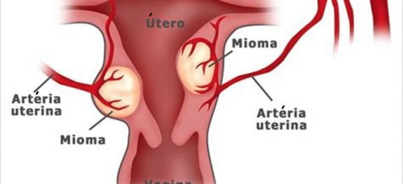 cistos_e_mioma