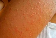 gluten_-_intolerancia