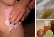 mel_-_adesivo_-_tosse_novo