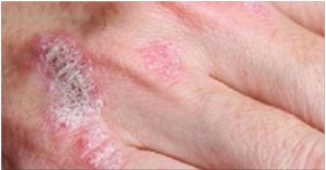 psoriase
