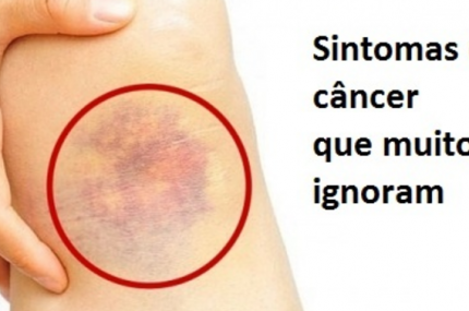10 sintomas de câncer que muitos ignoram - Veja a Receita: 10 sintomas de câncer que muitos ignoram - Veja a Receita: